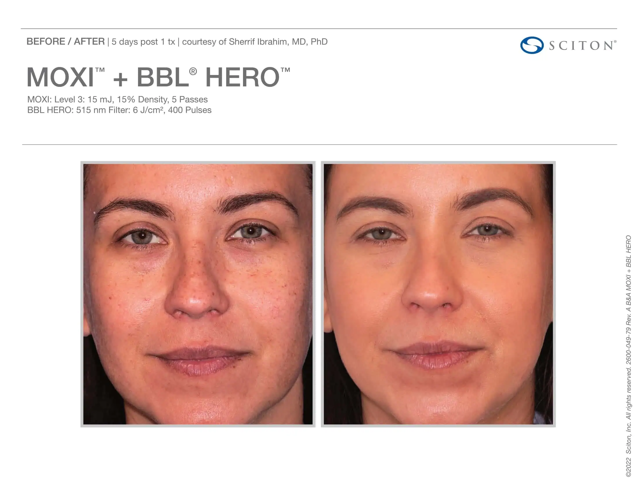 BBL + Moxi Before & After 3