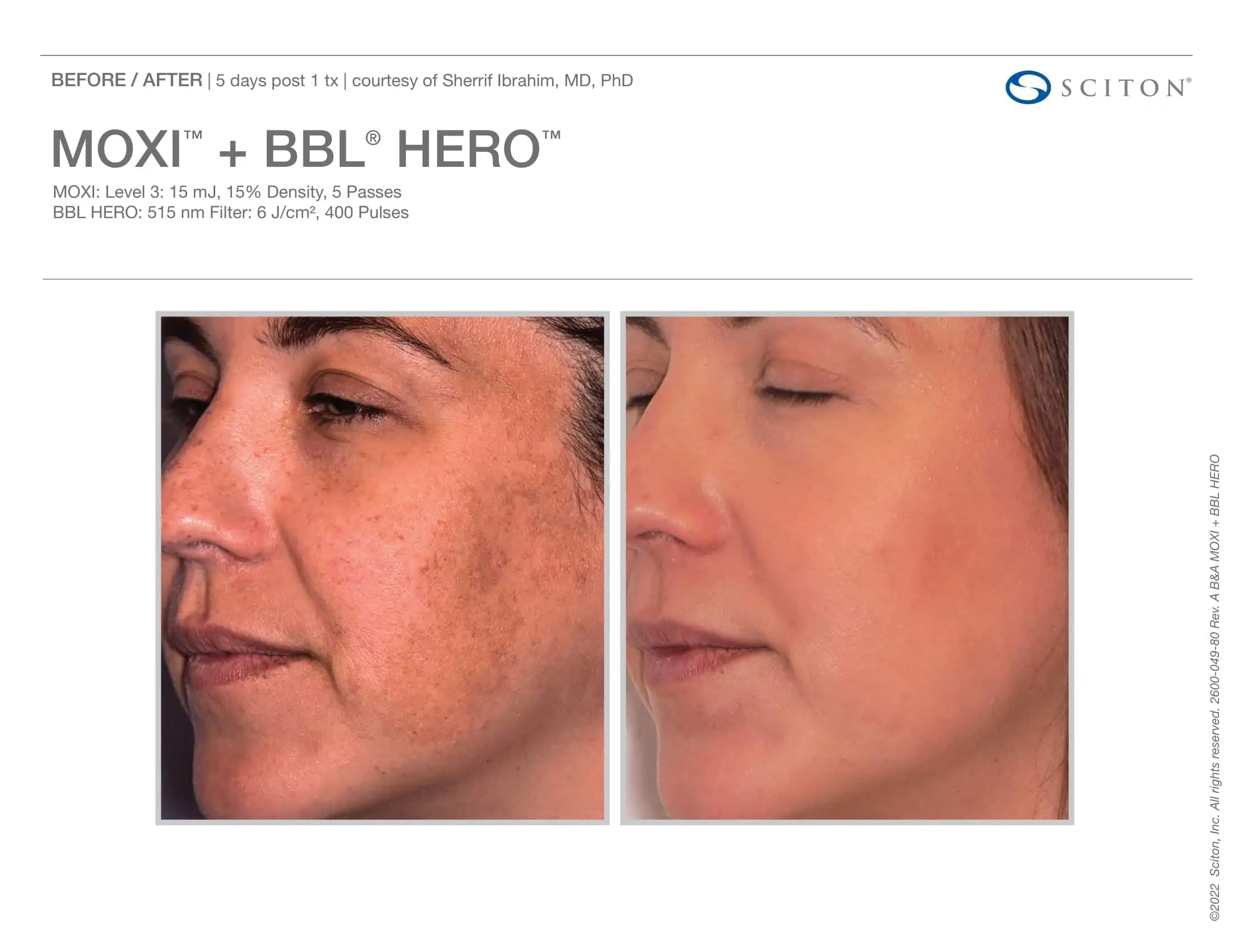 BBL + Moxi Before & After 4