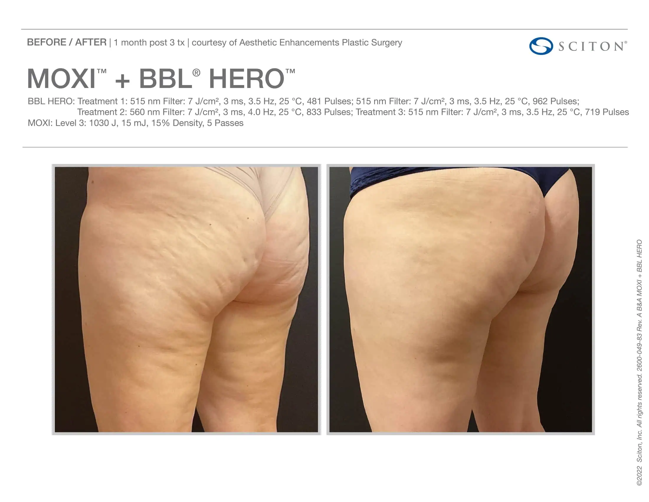 BBL + Moxi Before & After 5