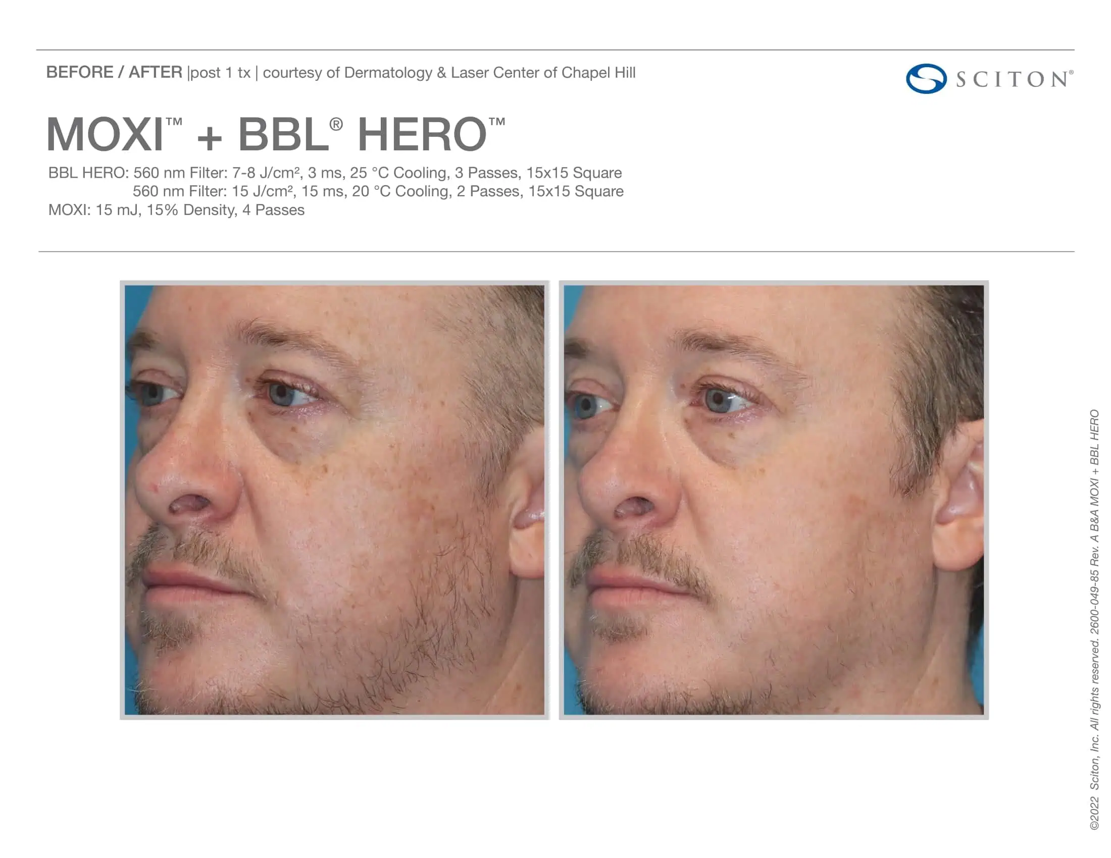 BBL + Moxi Before & After 6