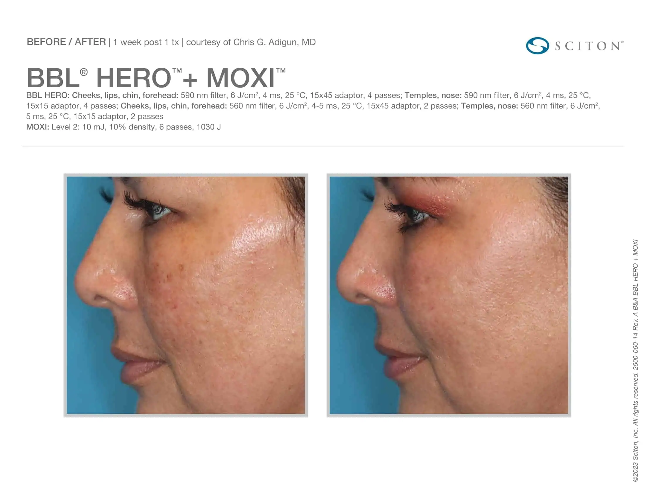 BBL + Moxi Before & After 9