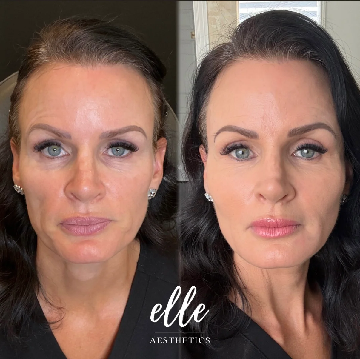 Radiesse® 1 Before and after Radiesse treatment showing smoother forehead lines and fuller lips