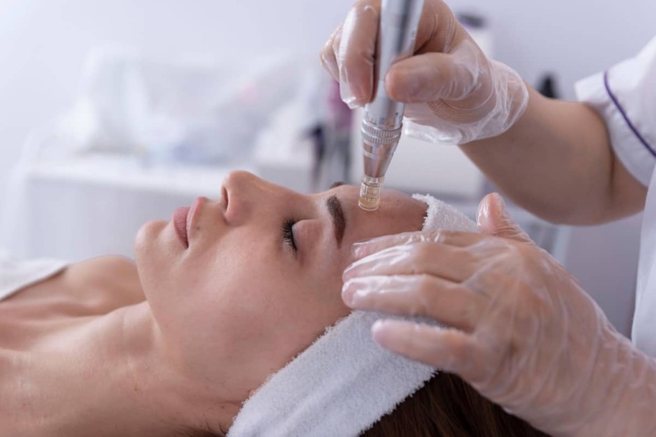 Microneedling for Acne Scars and Wrinkles: Does It Really Work? 2 Microneedling by Elle Aesthetics in Mapleton UT