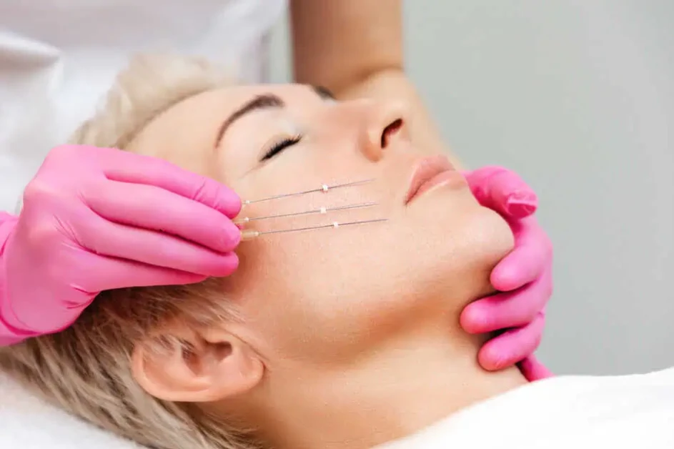 How PDO Threads Enhance Facial Contours for a Sculpted Look 2 PDO Threads by Elle Aesthetics Utah in Mapleton, Utah