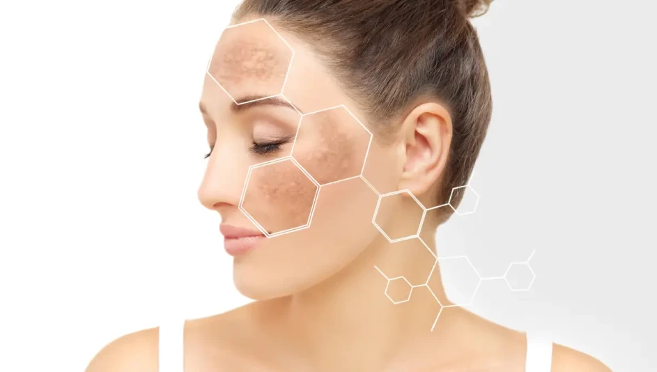 Chemical Peels for Hyperpigmentation: Even Out Skin Tone Fast 1 Chemical Peels for Hyperpigmentation in St Heber City, UT