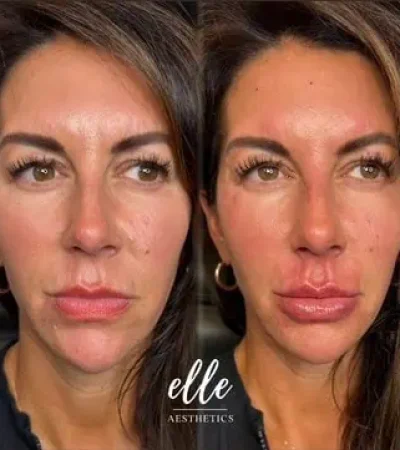 Dermal Fillers 22 image0