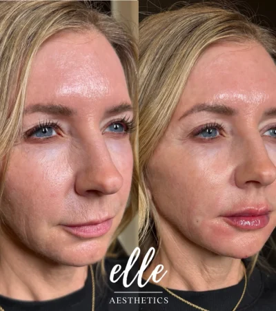 Dermal Fillers 3 Before and After Image
