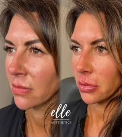 Dermal Fillers 21 image1