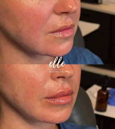 Dermal Fillers 20 image2