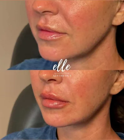 Dermal Fillers 19 image3