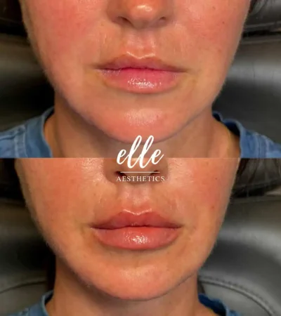 Dermal Fillers 18 image4