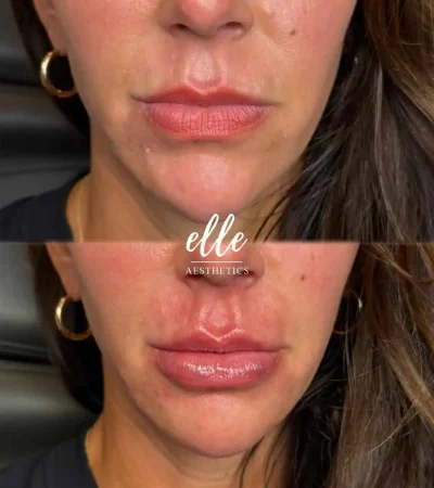Dermal Fillers 17 image5