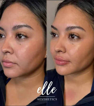 Dermal Fillers 16 image6