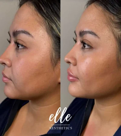 Dermal Fillers 15 image7
