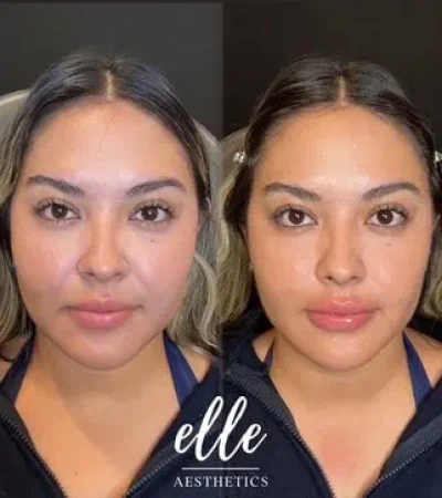 Dermal Fillers 14 image8