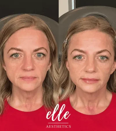 Dermal Fillers 13 image9